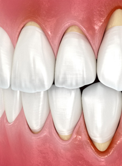 Illustration of gum recession