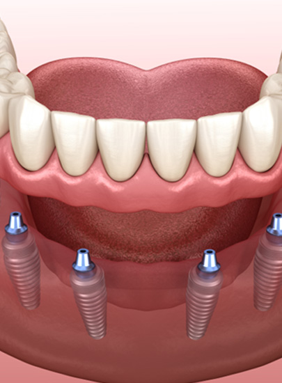 Illustration of dentures being attached to dental implants