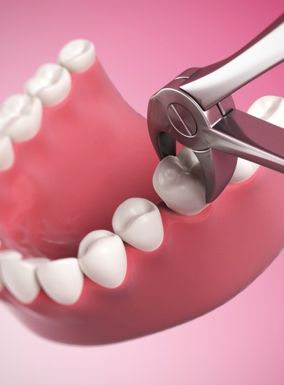 Illustration of a tooth extraction